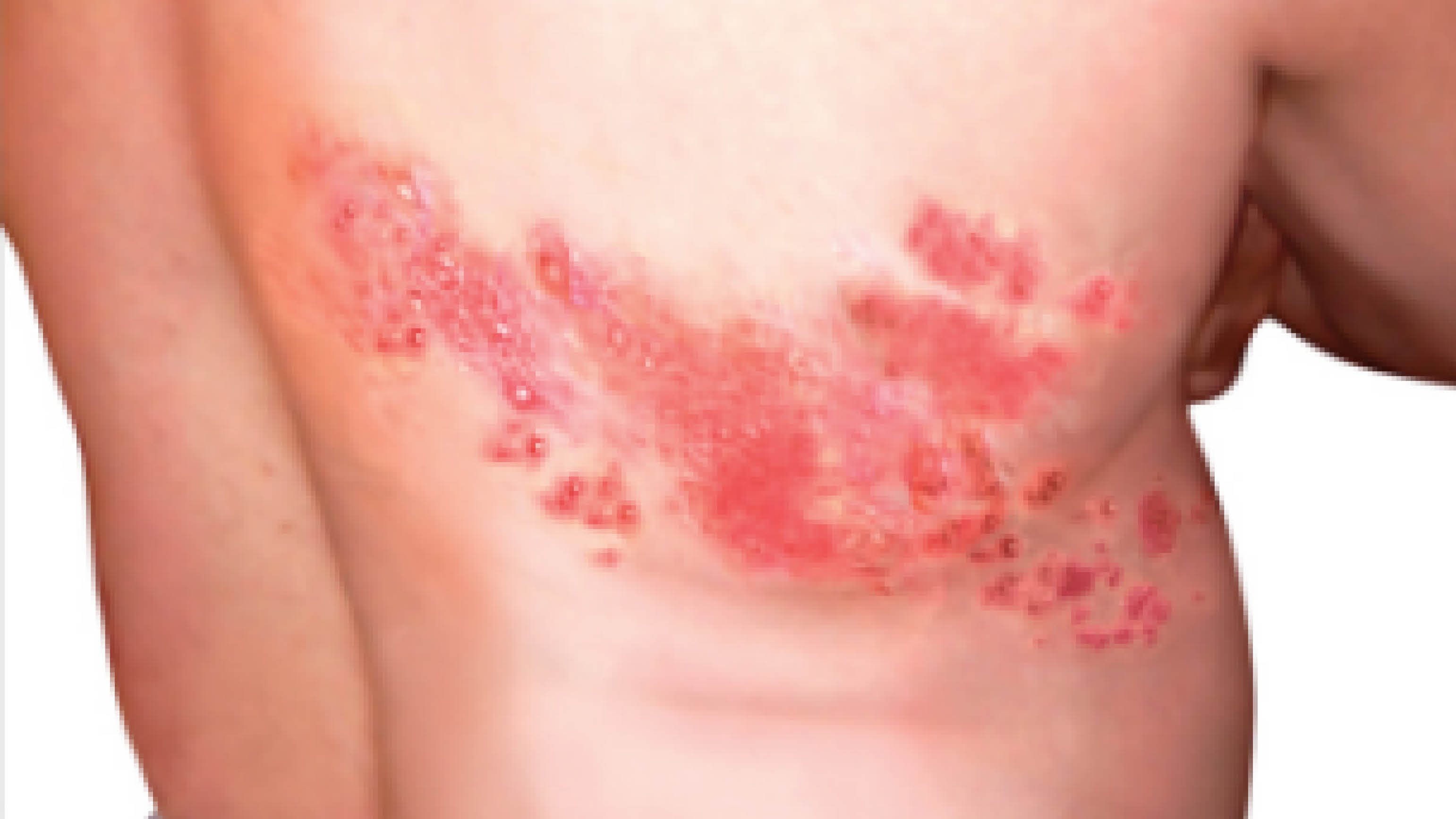 Picture of shingles on back