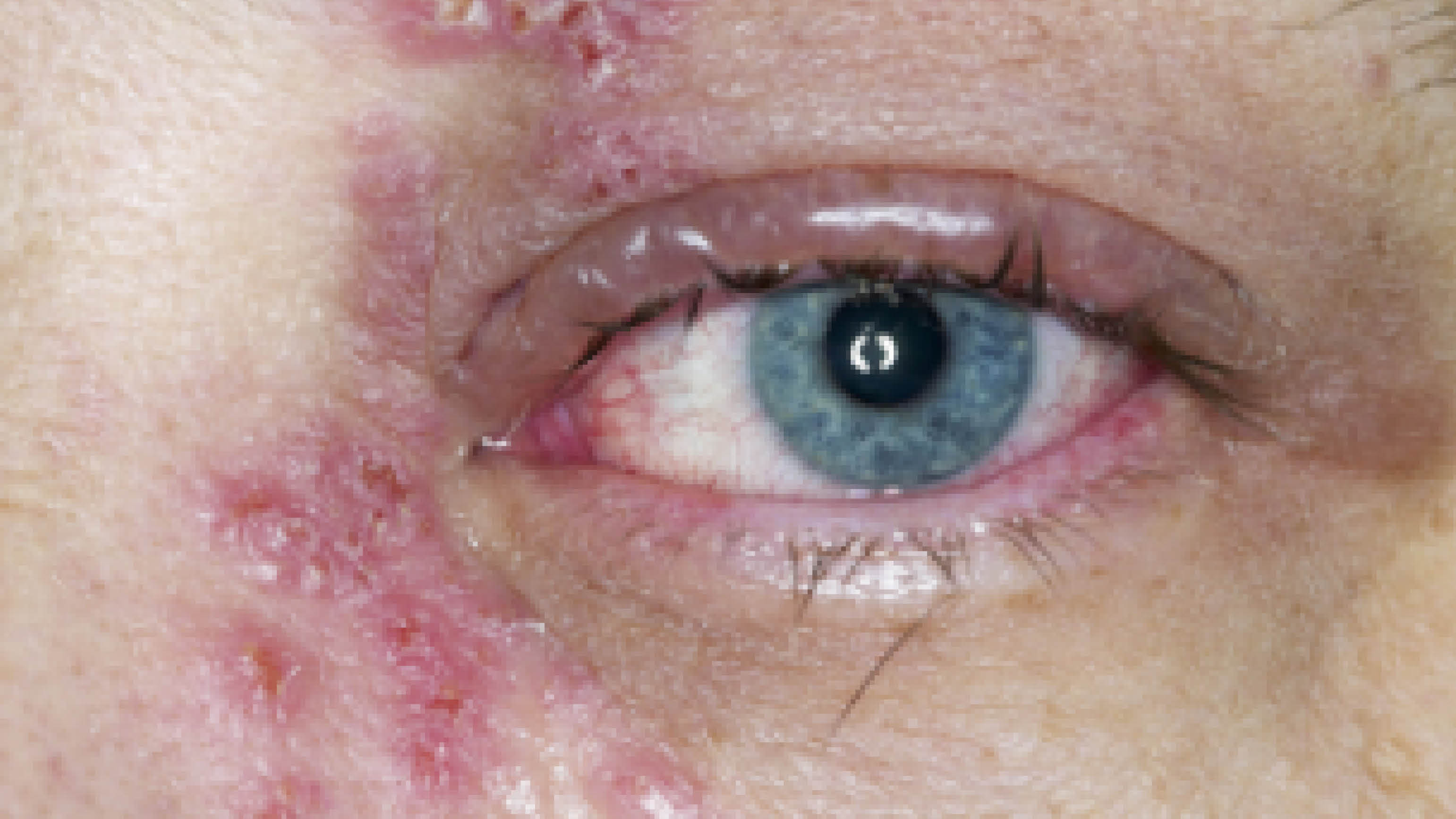 Picture of shingles on face