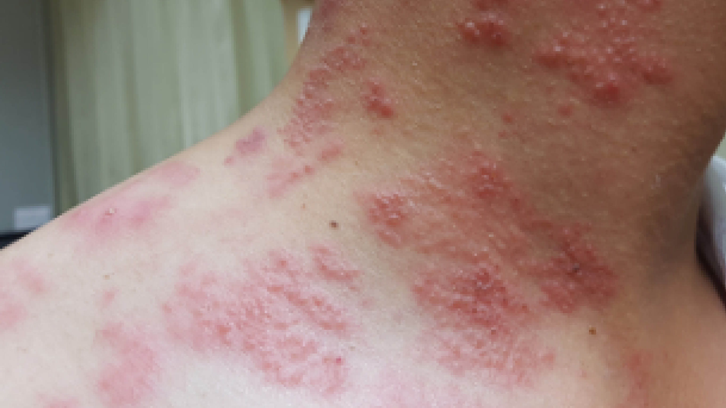 Picture of shingles on neck